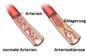 Arterienablagerungen bei Arteriosklerose